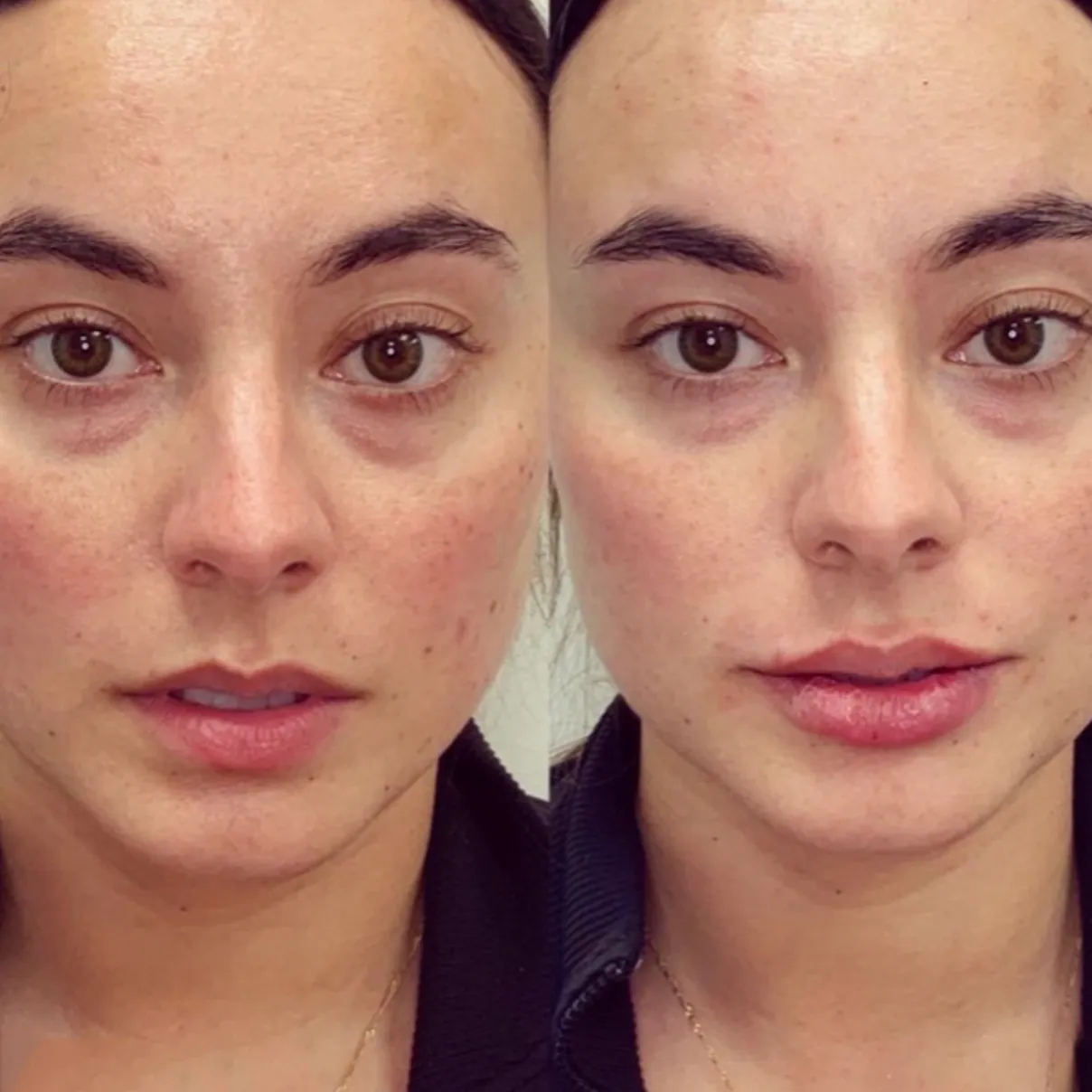 Lip filler before and after 1