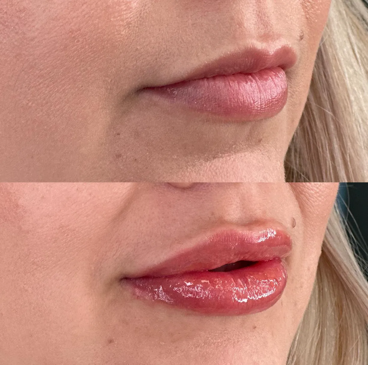 Lip filler before and after 2