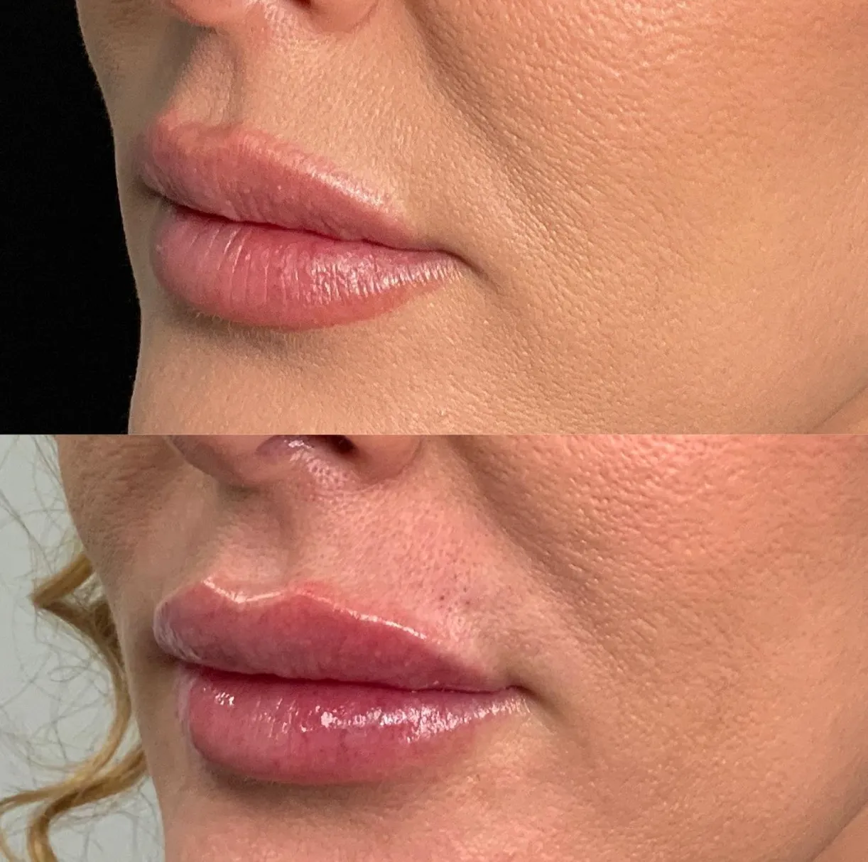 Lip filler before and after 3